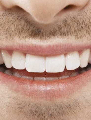 lach-met-witte-tanden