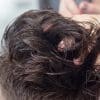 Je wilde haren terug met een haartransplantatie