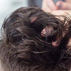 Je wilde haren terug met een haartransplantatie