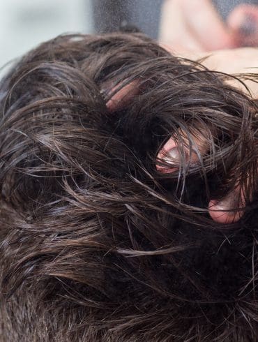 Je wilde haren terug met een haartransplantatie